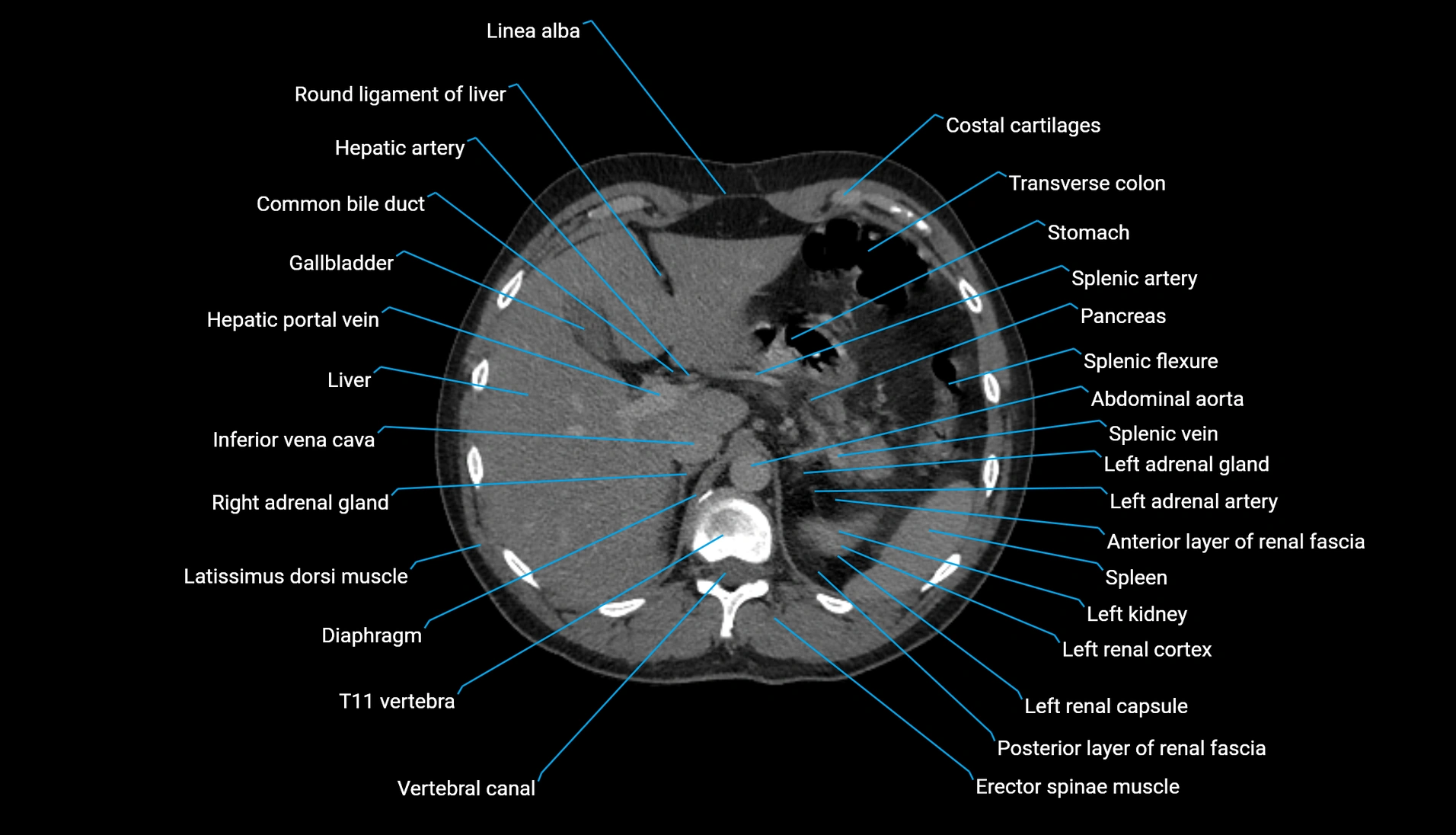 CT urogram axial cross sectional anatomy  labelled radiology image-00071.webp